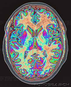 頭蓋骨のMRI断層写真画像